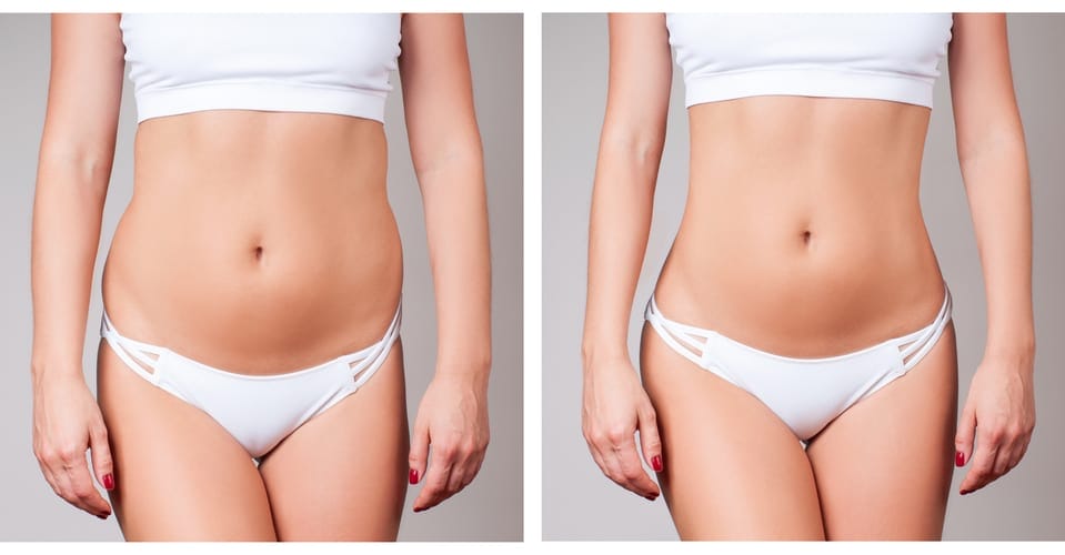 Liposuction