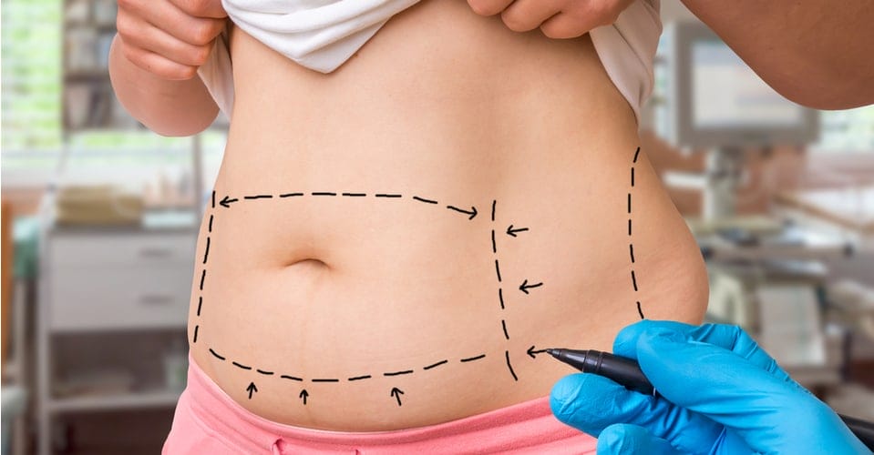 Tummy Tuck