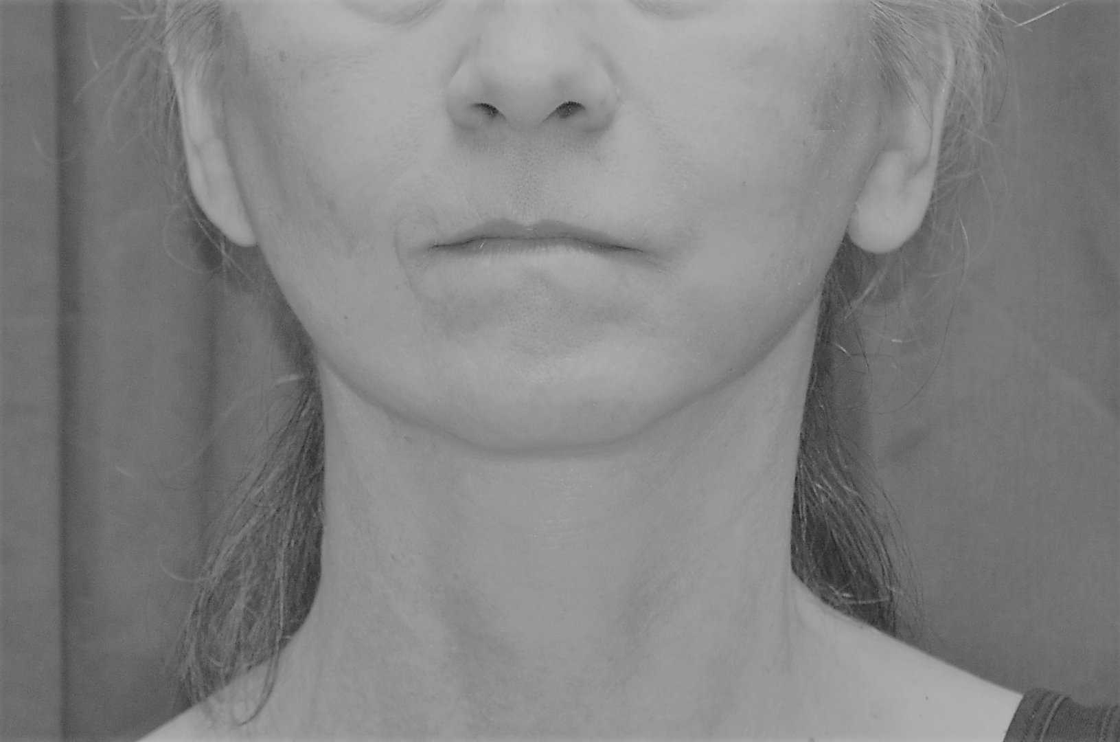 Face neck front view 6 day post op BW
