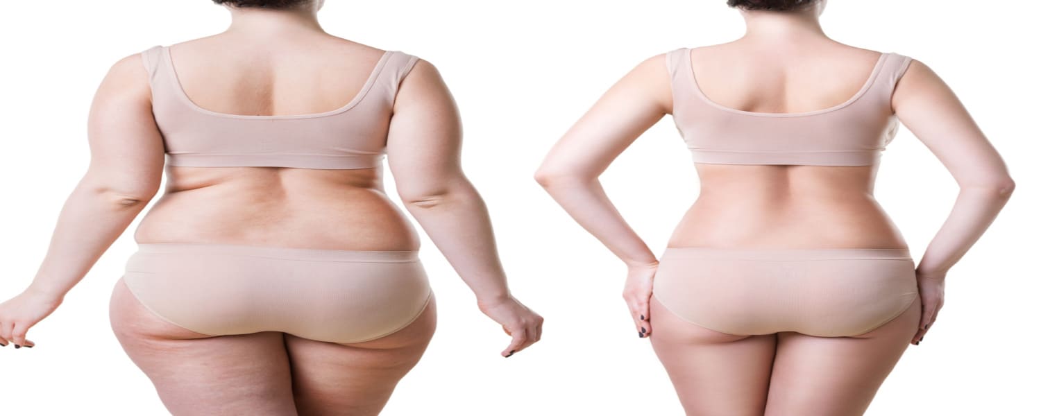 Liposuction Machesney Park IL