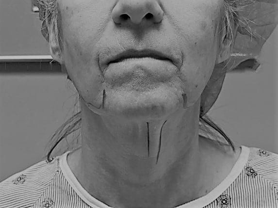 RP preop face and neck BW