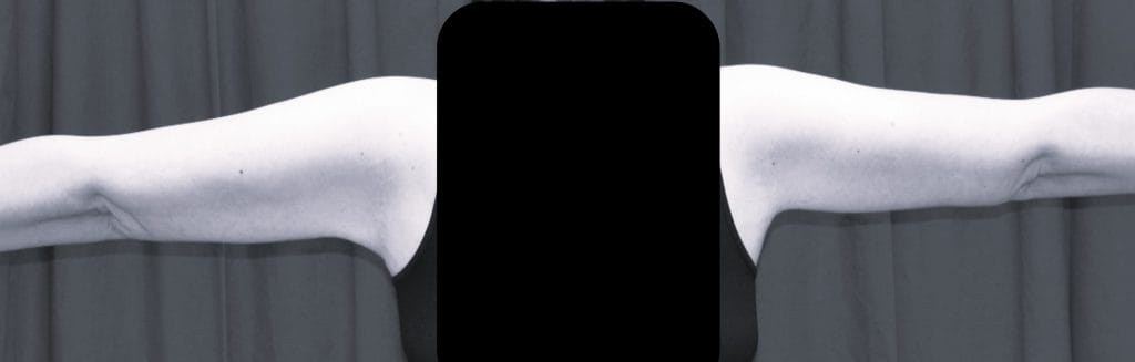 back view 5 months postop back view 5 months postop