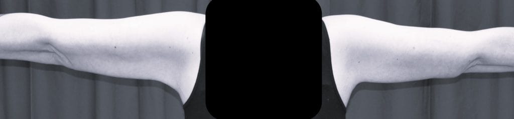 back view 6 weeks postop back view 6 weeks postop