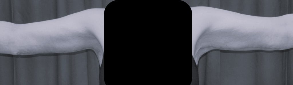 front 6 weeks postop front 6 weeks postop