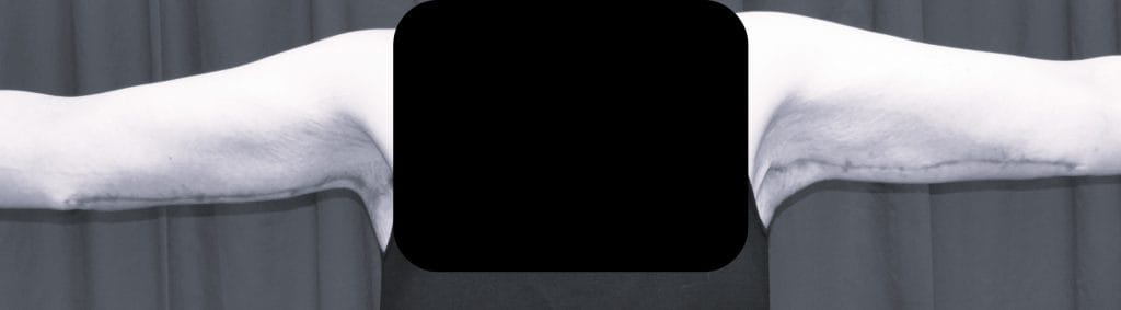 front view 5 month postop front view 5 month postop